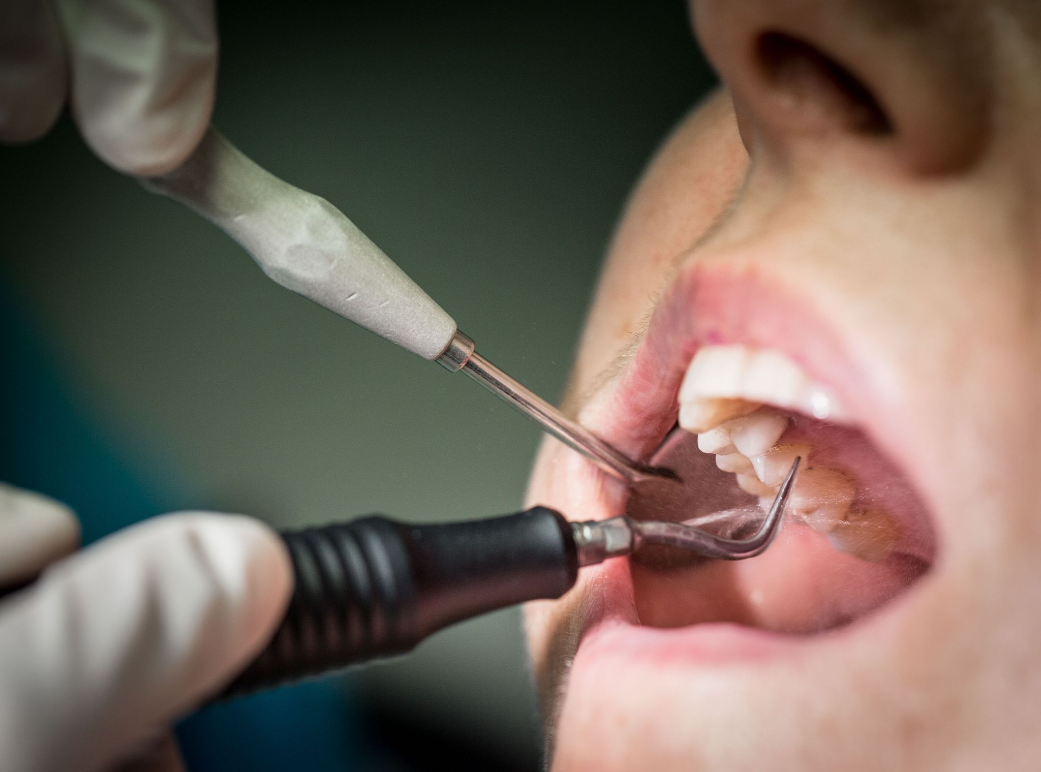 Wer regelmäßig zur Vorsorge geht und seine Zähne professionell reinigen lässt, kann Parodontitis vorbeugen. Besonders wichtig ist das für Diabetiker.