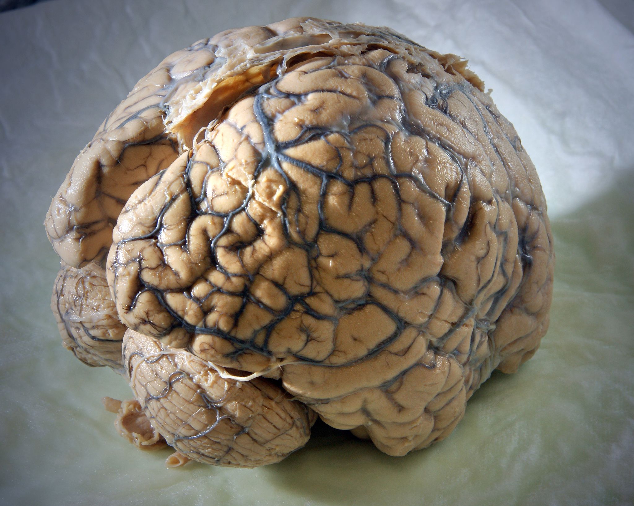 Ein Gehirn des Menschen in einem Labor der Klinik für Neurologie am Universitätsklinikum Jena.