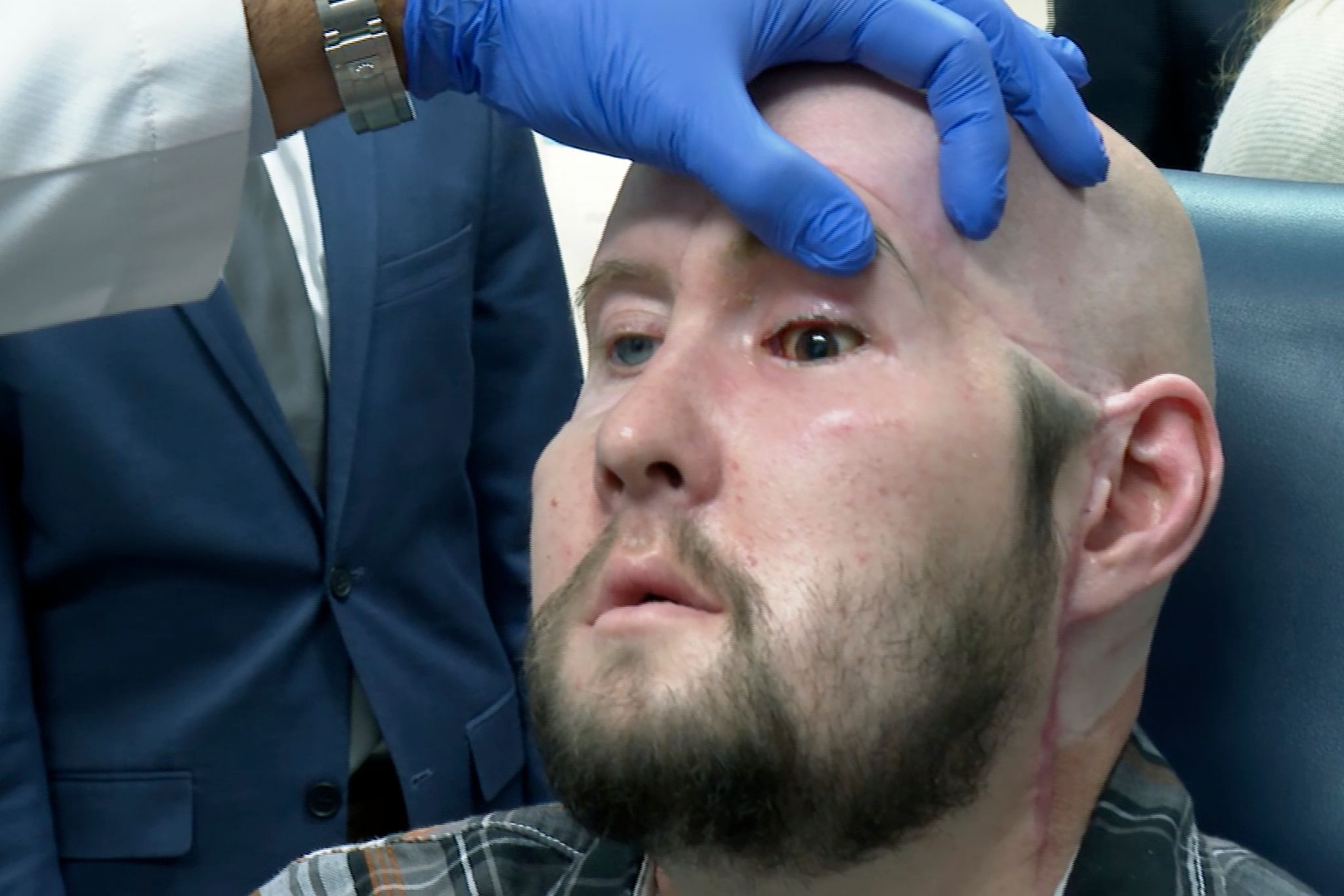 Einem US-amerikanischen Chirurgenteam ist eigenen Angaben zufolge die erste vollständige Augentransplantation weltweit gelungen.