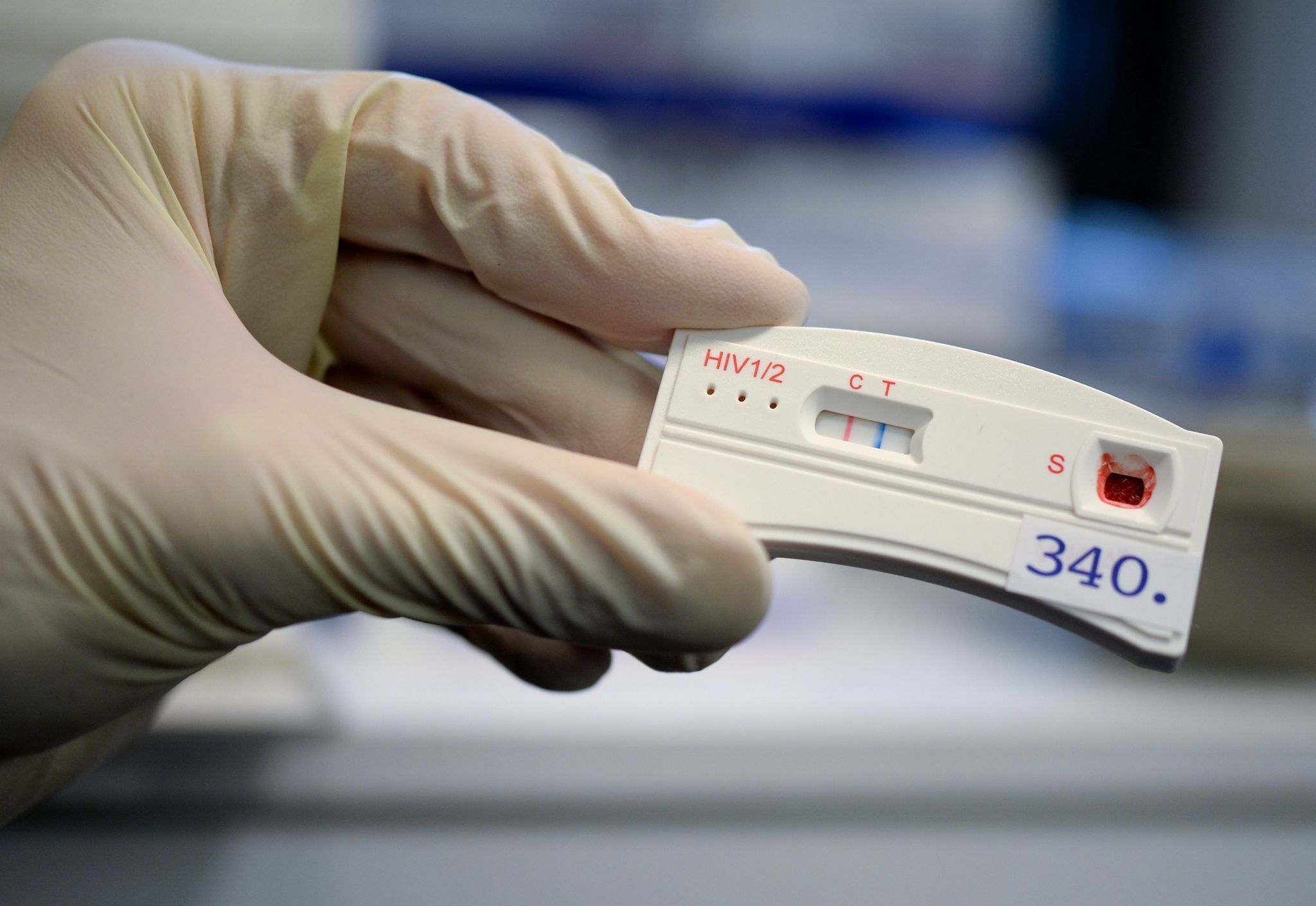 Der Teststreifen an einem HIV-Schnelltest verfärbt sich bei der Berliner Aids-Hilfe nach der Anwendung mit dem Blut einer Testperson.