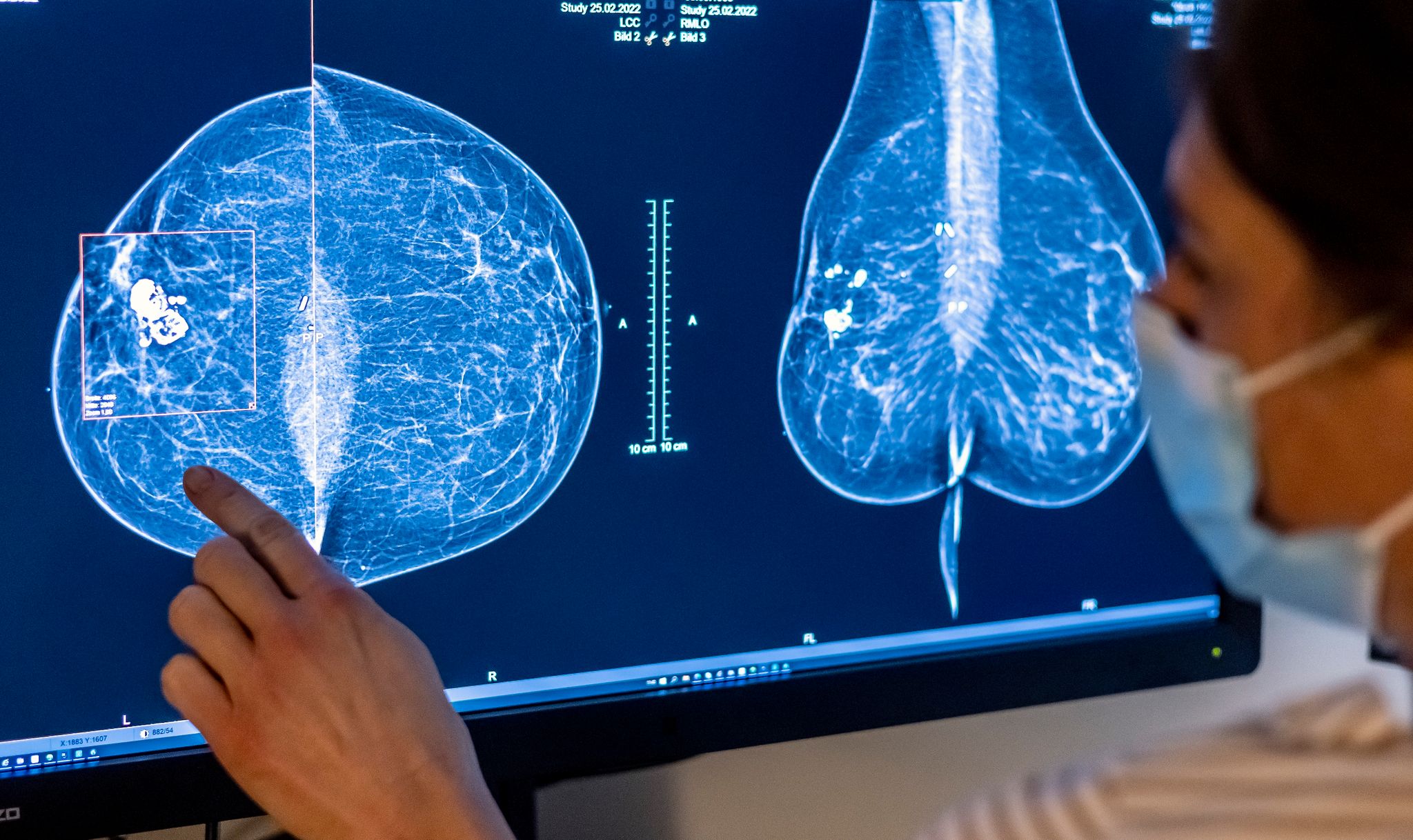 Brustkrebs ist die häufigste Krebserkrankung bei Frauen in Deutschland.